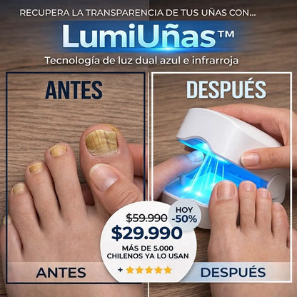 LumiUñas: Elimina Hongos de las Uñas